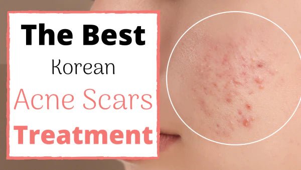 Acne - Koreanskincare